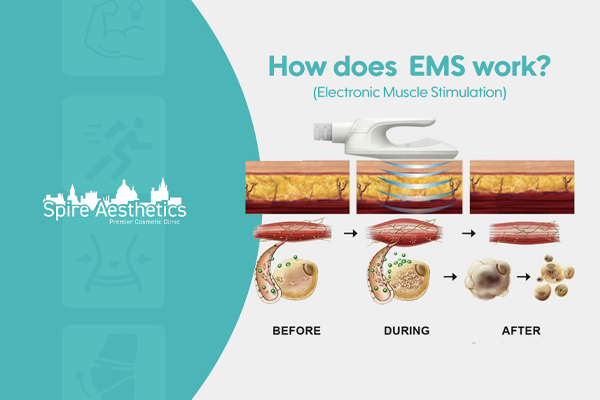 EMS treatment for post pregnancy weight loss treatment Smallwood