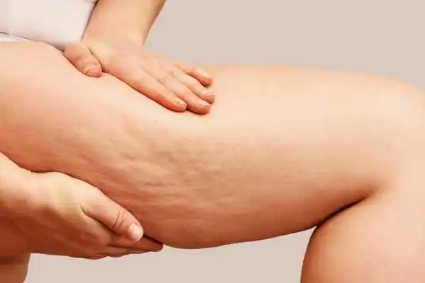 Image of woman showing leg with cellulite Smallwood