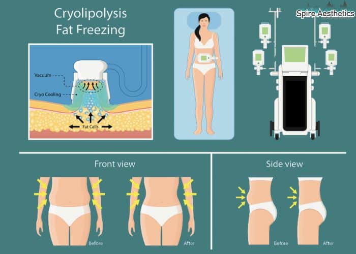 Image of diet and fat freezing combined for best results for Spire Aesthetics Smallwood