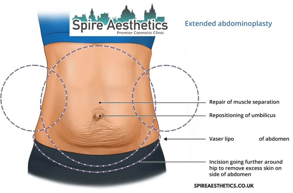 Understanding Loose Skin After Gastric Band Smallwood Surgery and HIFU Treatment