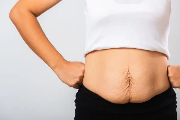 Image of a woman's stomach after weight loss with sagging skin following a gastric band Smallwood