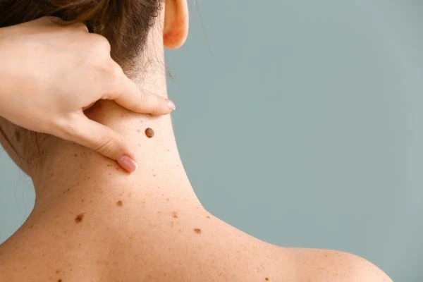 skin blemish removal Smallwood treatment